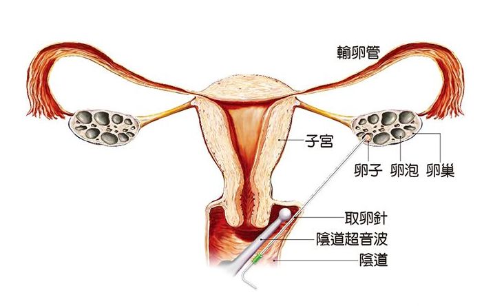 第三代供卵试管婴儿PGD-PGS、T、NGS、AFGH、FISH，傻傻分不清楚