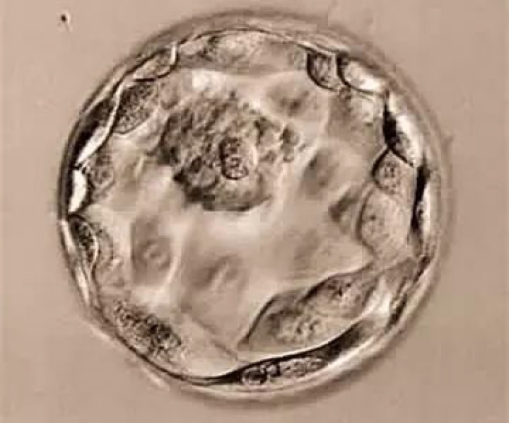 供卵试管婴儿移植中应放置多少个胚胎才能提